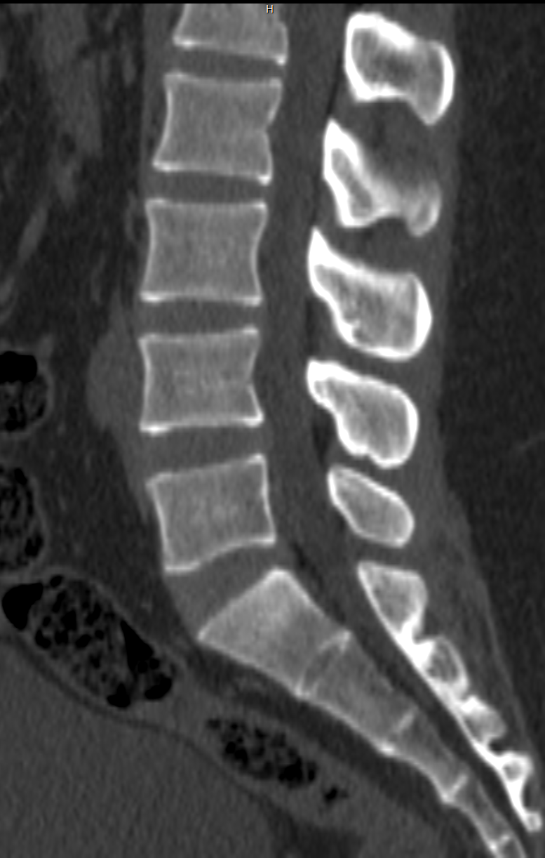 CT Scan Image of Lumbar Spine Obraz tomografii komputerowej kręgosłupa lędźwiowego