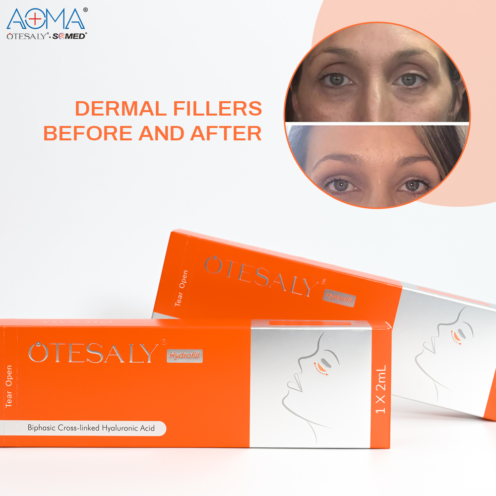 AOMA Hydrofill Dermal Filler AOMA Hydrofill 真皮填充剂