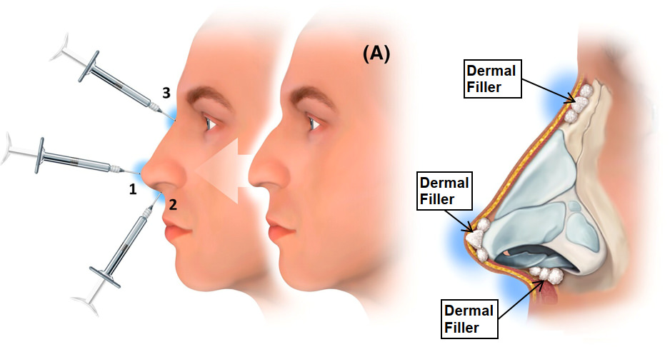 Dermal Filler Treatment Area 真皮填充剂改善区域