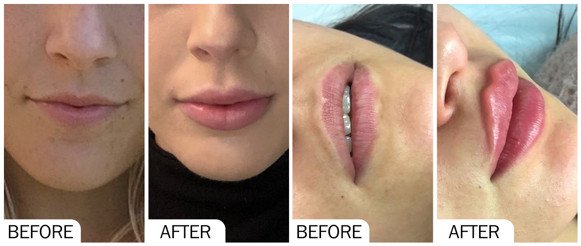 Before and After Lip filler AOMA 唇部填充术之前和之后 AOMA