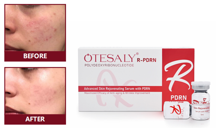 AOMA R-PDRN AOMA R-PDRN