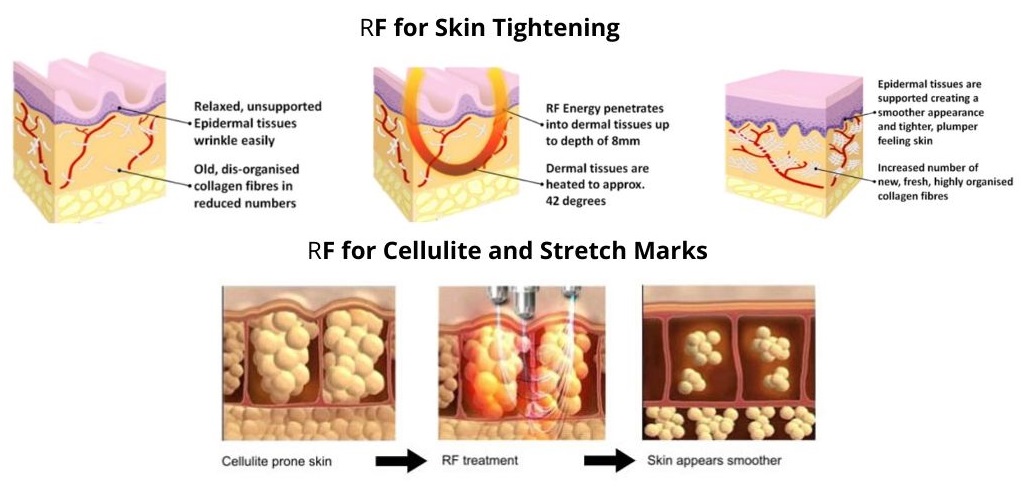 RF for skin tightening RF pour le raffermissement de la peau