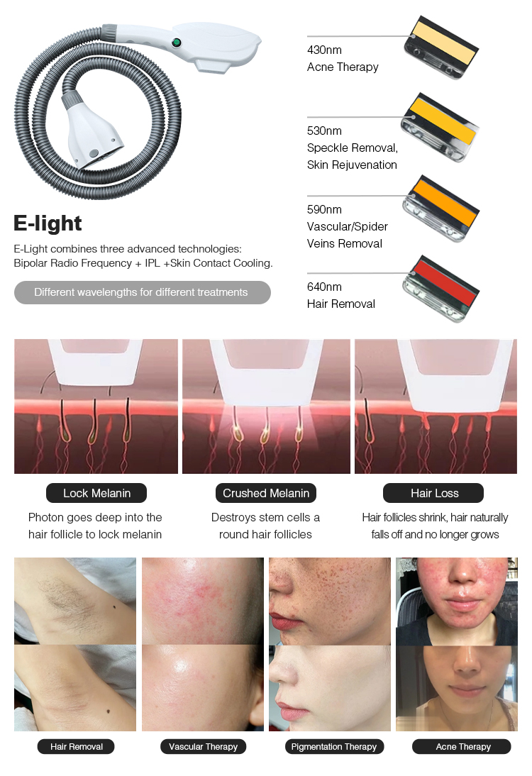 SHR IPL YAG RF Laser Hair Removal Machine Machine d'épilation au laser SHR IPL YAG RF