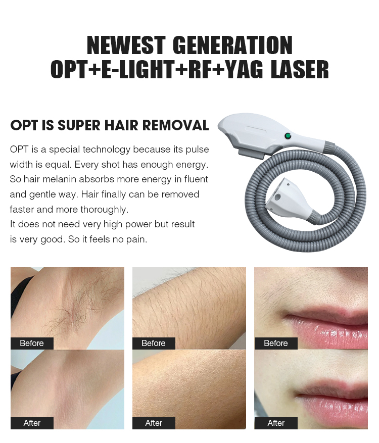 SHR IPL YAG RF Laser Hair Removal Machine Machine d'épilation au laser SHR IPL YAG RF