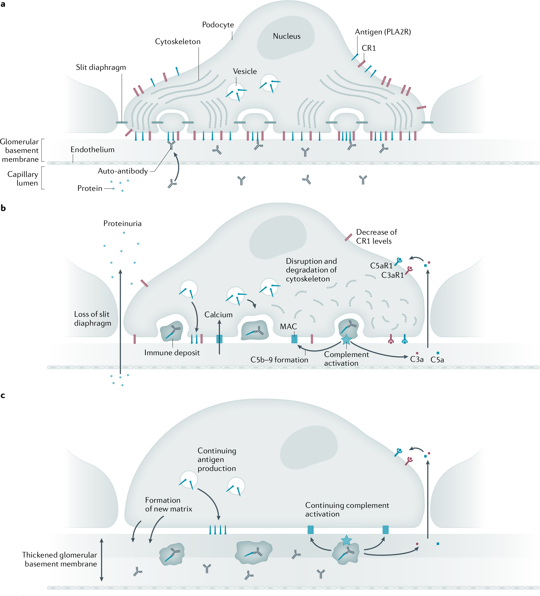 Membranous nephropathy(1)-8 គ្រឿងសំអាងគ្រឿងសេជ្រឯក (1) -8