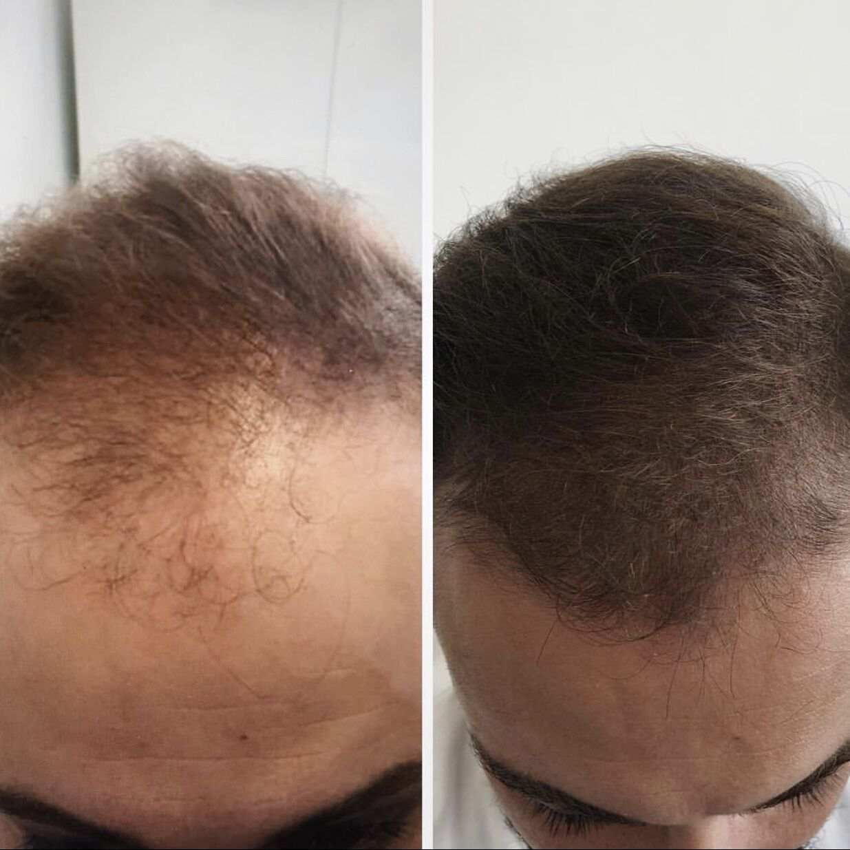 hair restoration mesotherapy case results 毛发养护美塑疗法案例结果