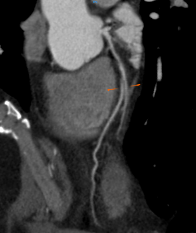 CT Angiography (CTA) Scan of the Coronary Artery (1) Angiografia CT (CTA) Skanowanie tętnicy wieńcowej (1)