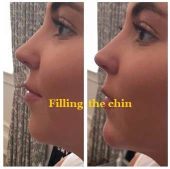 Filling The Chin For AOMA 為 AOMA 填補下巴