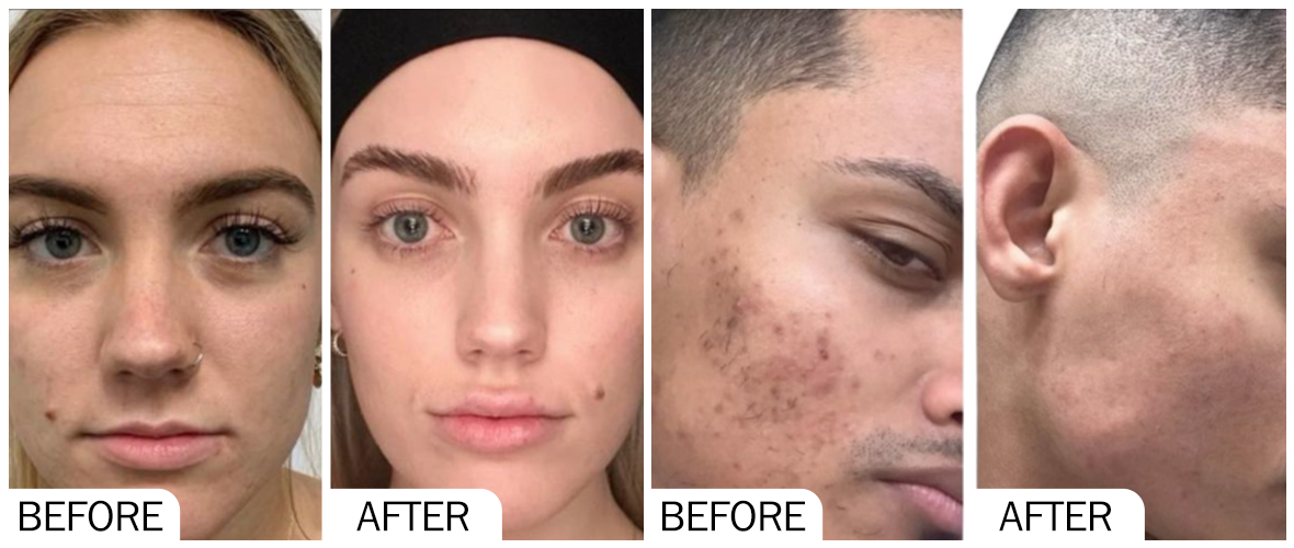 Before & After pictures of AOMA R-PDRN AOMA R-PDRN 之前和之后的照片