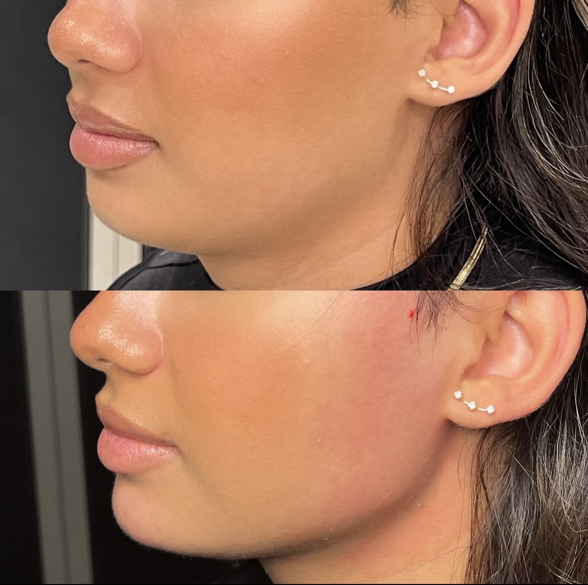 AOMA Before & After of Cahafill 2ml AOMA Cahafill 2ml 之前和之后