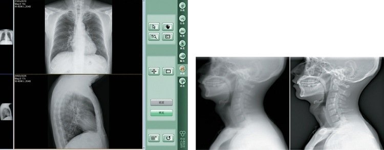Radiografia del sistema ad alta frequenza digitale a raggi X