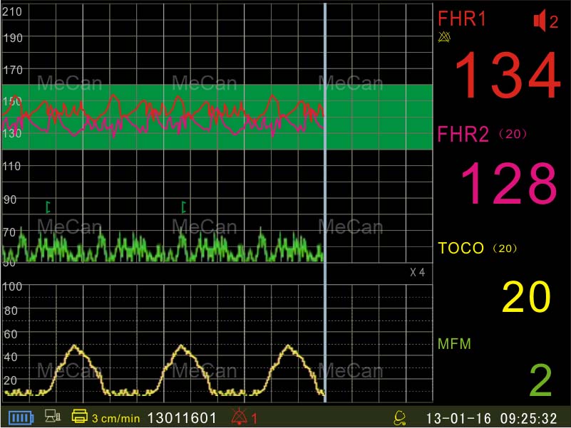 vaisiaus motinos monitorius ir vaisiaus sąsaja