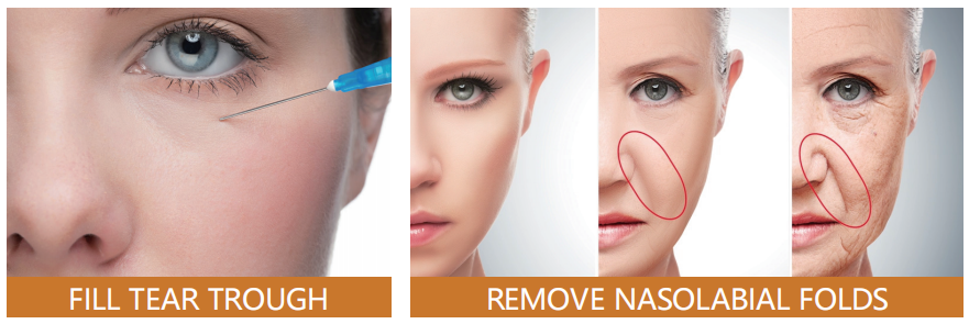 AOMA Vital 2ML 填充剂前后对比图