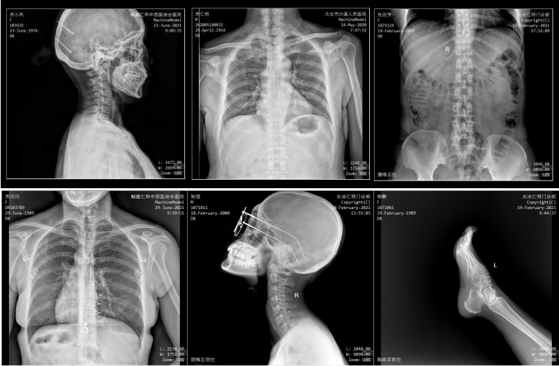 Sistema sa Digital X-ray nga Gi-mount sa kisame