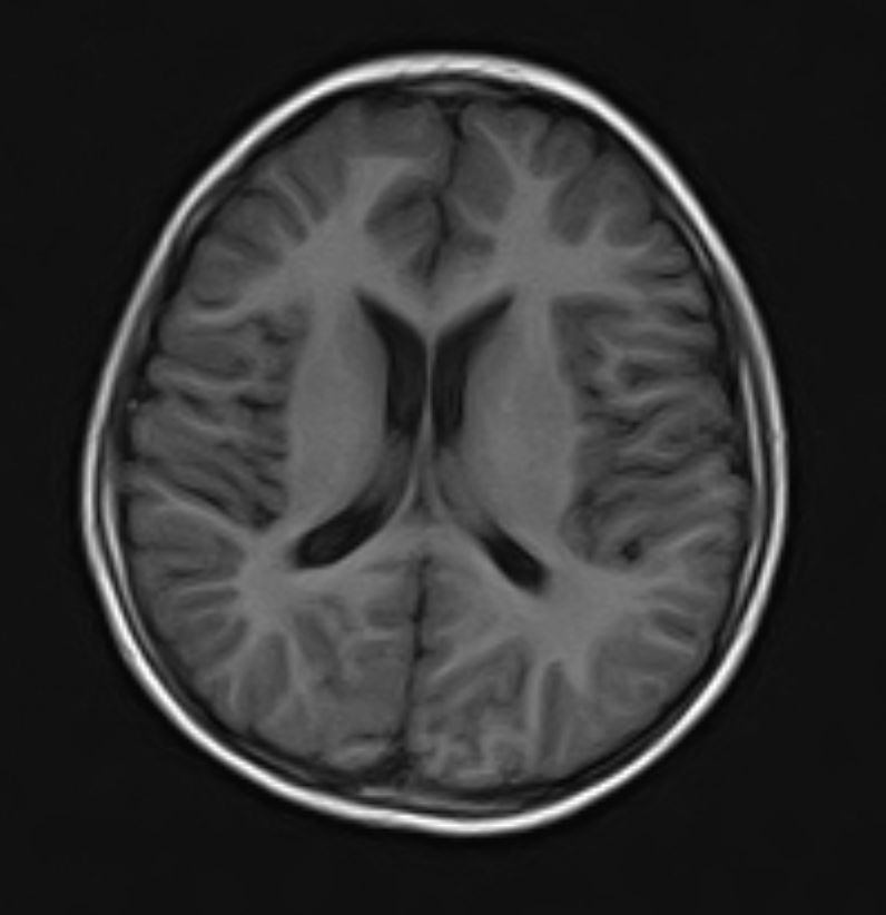 axial-brain-mri-scan-ventricles-gyri