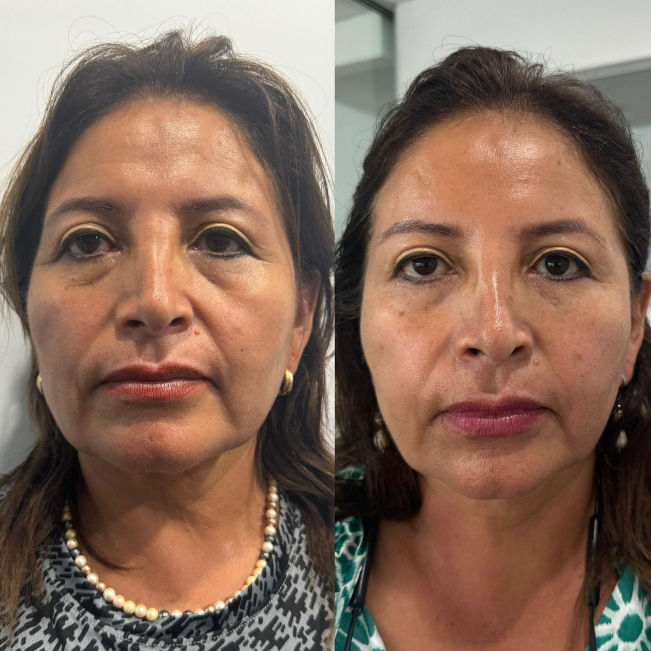 AOMA Facefill 抗皱填充剂