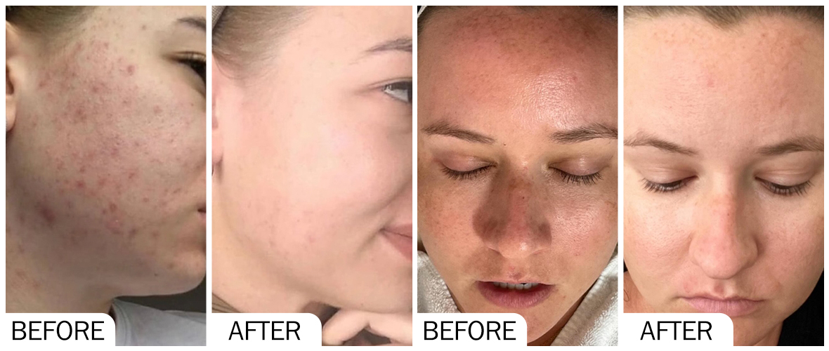 AOMA 皮膚提亮膚色前後