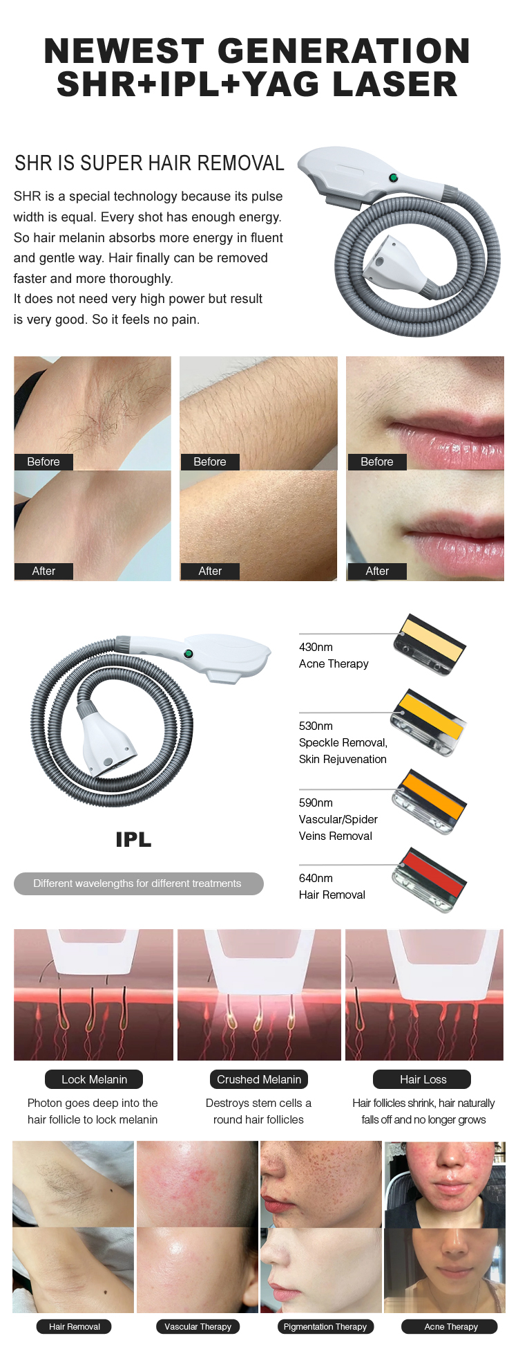 &Eacute;pilation IPL SHR