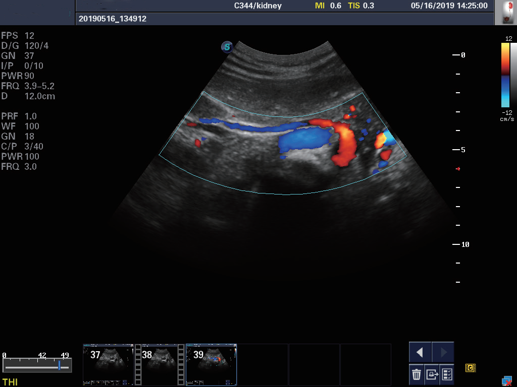 Imatge de la m&agrave;quina d'ecografia Doppler en color del carro SonoScape S11 Plus