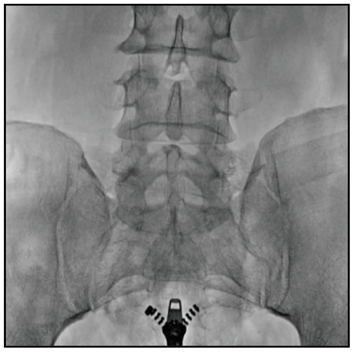 MS-C8800 Mobile FPD C-arm X-Ray Equipment (with laser position)